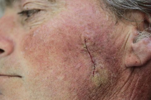 Photo - BCC 1b - after - eliptical excision.JPG
