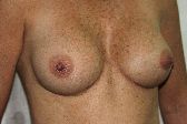 Photo - Breast Augmentation MORE DETAILS - OLD - 1a - LONG TERM RESULTS.JPG