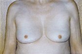 Photo - Breast Augmentation MORE DETAILS - OLD - 1b - REMOVAL OF PROSTHESES.jpg