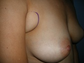 Photo - Breast Augmentation Surgery Sydney - 4b - HIGH PROFILE.JPG