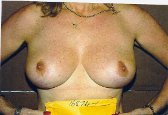 Photo - Breast Reduction - OLD - MORE INFO - 1c - AFTER SURGERY.jpg