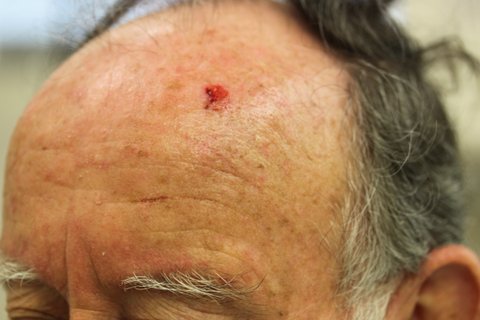 Photo - Detailed Skin Cancer Information - Basal Cell Cancer - 1