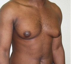 Photo - Gynecomastia Man Boobs Surgery Sydney - 2a - BEFORE SURGERY PIC - SMALL - SAMPLE ONLY.jpg