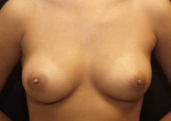 Photo - Inverted Nipple Repair Surgery Sydney - 2b - AFTER SURGERY PIC - SMALL - SAMPLE ONLY.jpg