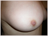 Photo - Inverted nipple detailed pic 1c.jpg