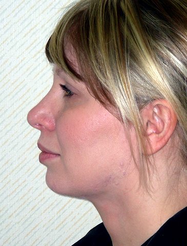 Photo - Neck Lift Surgery Sydney - 2b - AFTER SURGERY PIC - SMALL - SAMPLE ONLY.jpg