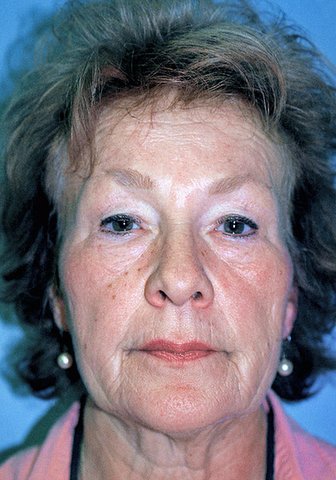 Photo - Short Scar Face Lift MACS Sydney - 1c - BEFORE SURGERY PIC - SMALL - SAMPLE ONLY.jpg