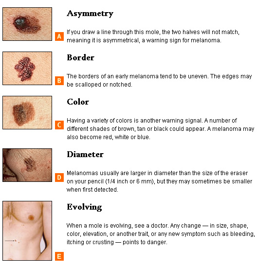 Photo - What is Skin Cancer 1 - SAMPLE ONLY.jpg