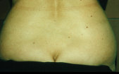 Photo - old - detailed liposuction 22.jpg