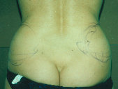 Photo - old - detailed liposuction 31.jpg