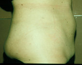 Photo - old - detailed liposuction 34.jpg